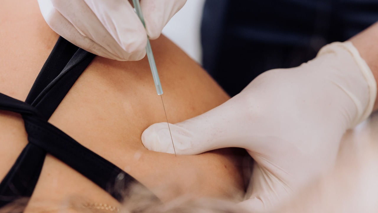 Dry needling - medicinska akupunktura